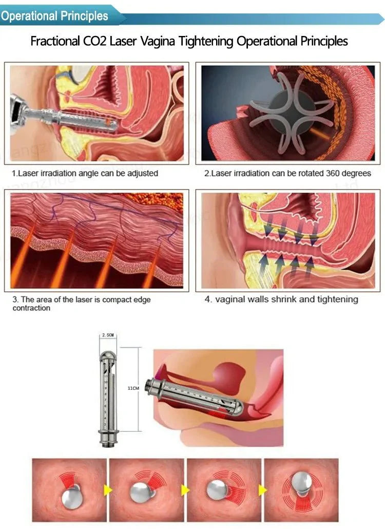 Dispositivo de terapia de reconstrucción microvascular con láser de puntos de CO2 Shape Tactics