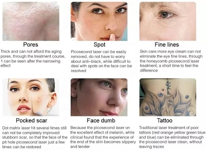 Shape Tactics: láser de picosegundos de precisión para eliminar pecas y tatuajes